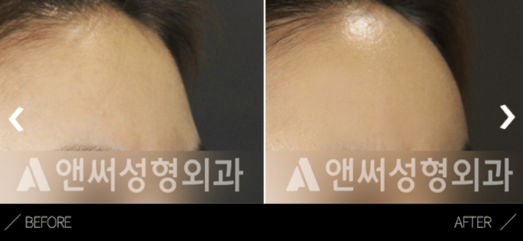 Fat Grafting Korea