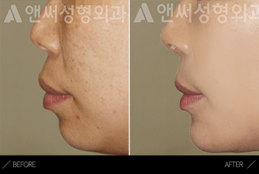Protrusion correction