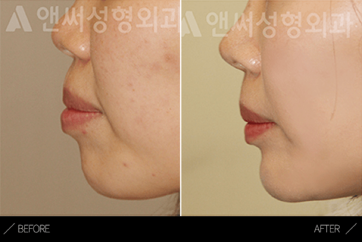 Protrusion correction