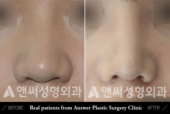 Blunt or Bulbous Tip Correction