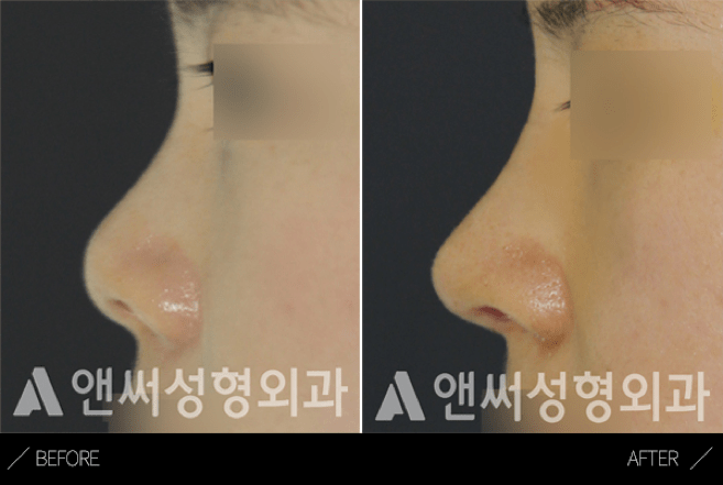 Short Nose Correction