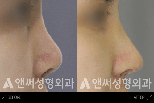 Short Nose Correction