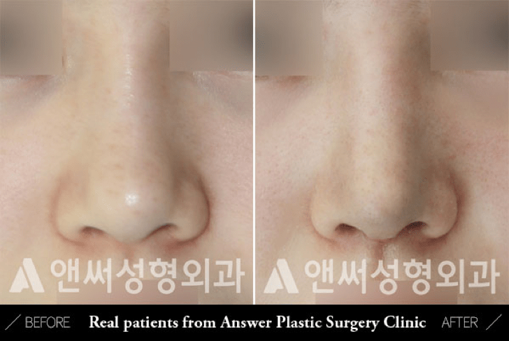 Blunt or Bulbous Tip Correction