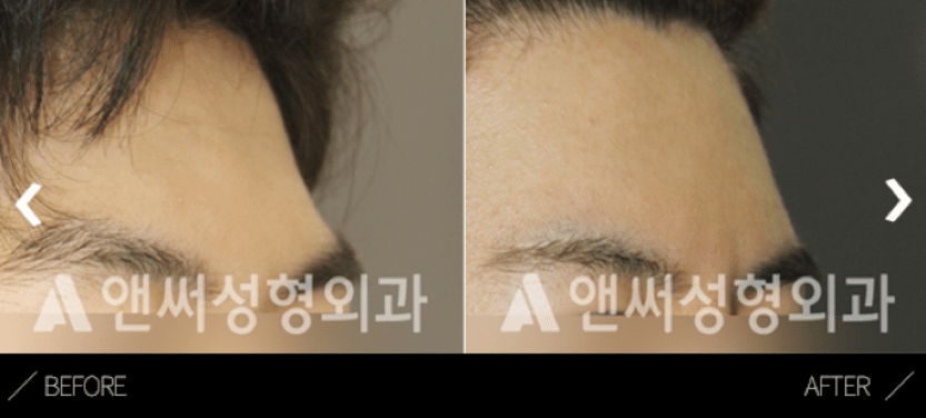 Fat Grafting Korea