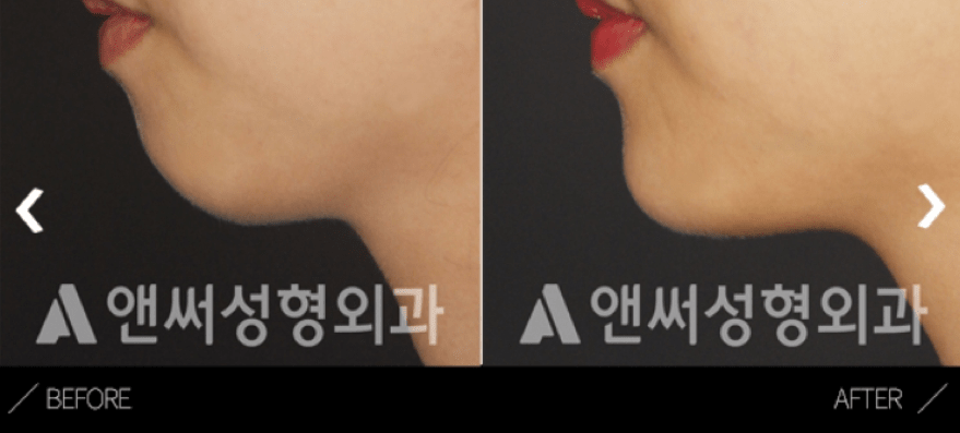 Fat Grafting Korea