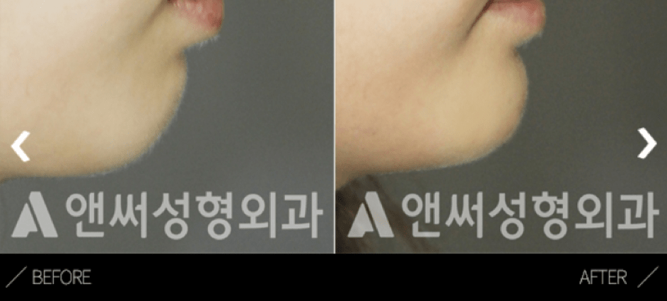 Fat Grafting Korea