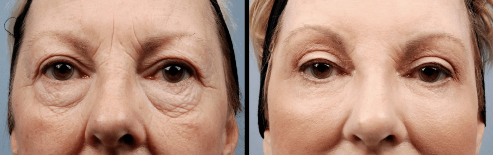 Fat Grafting Surgery In Korea, How Fat Grafting Works