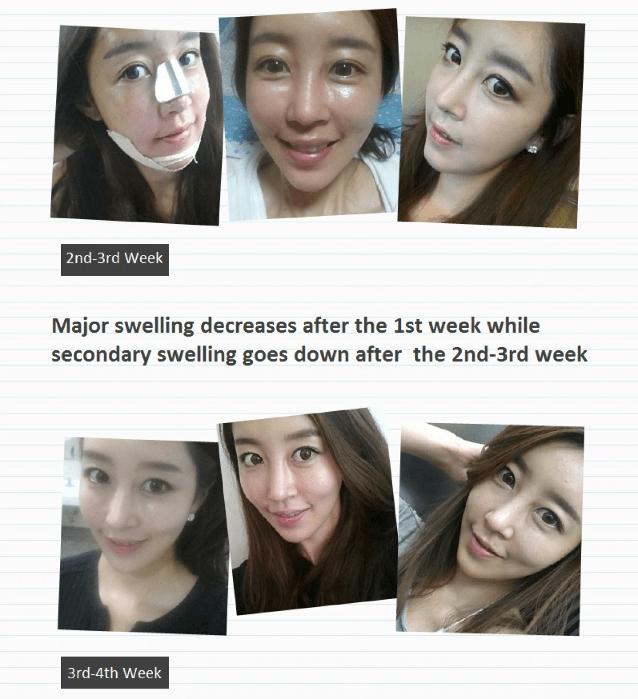 Fat Grafting, Facial Contouring, Rhinoplasty Before & After Fat Grafting, Facial Contouring, Rhinoplasty Before & After