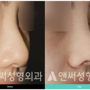 RHINOPLASTY RHINOPLASTY