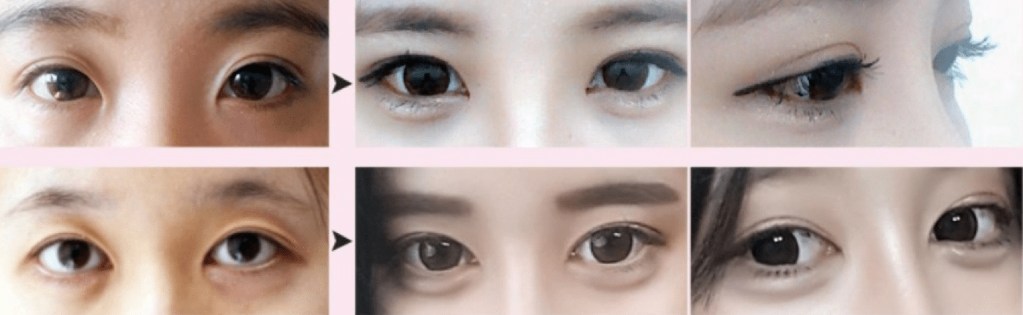 Under Eye Fat Removal & Repositioning