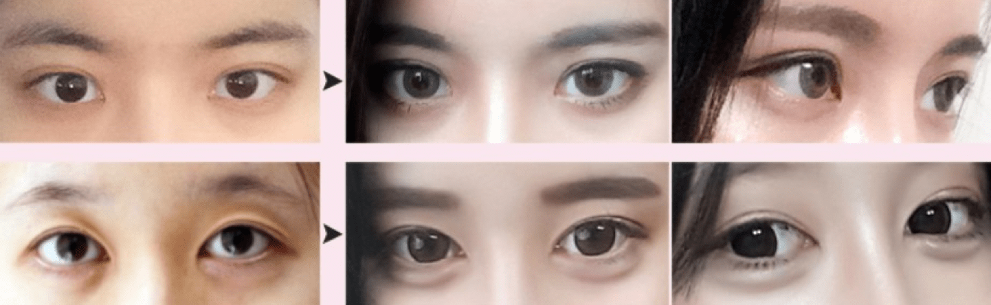 Ptosis Correction