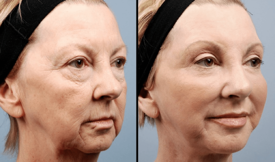 Fat Grafting Surgery In Korea, How Fat Grafting Works
