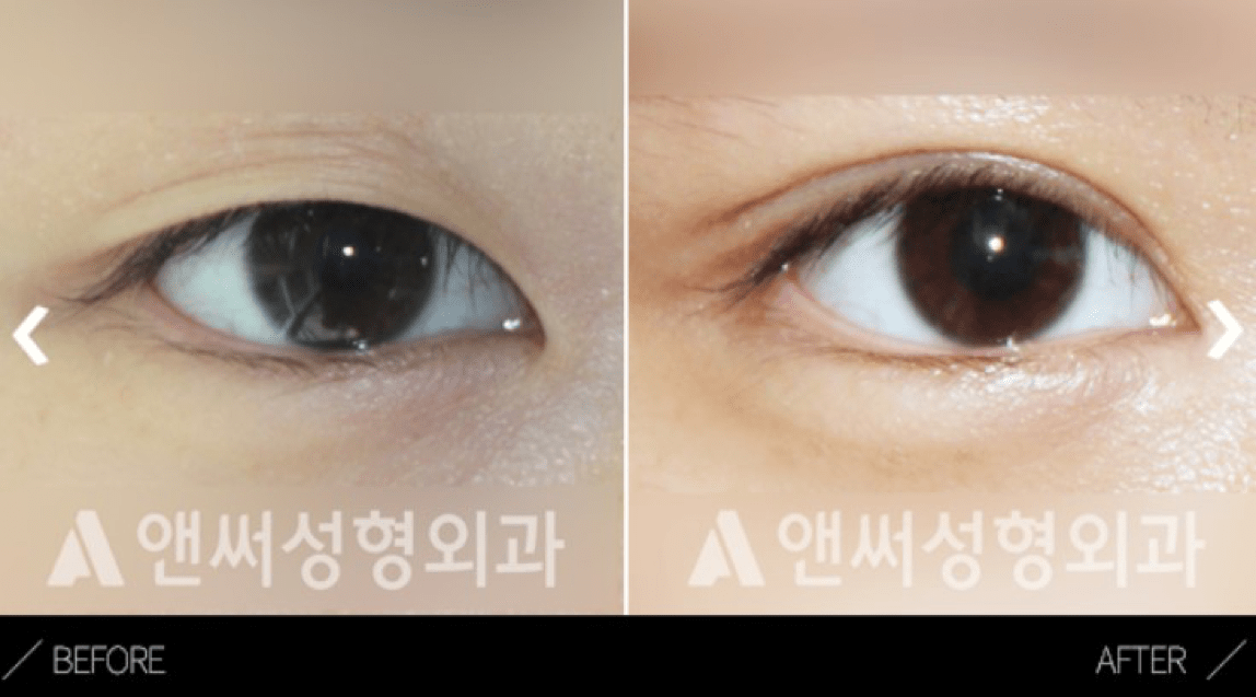 Ptosis Correction