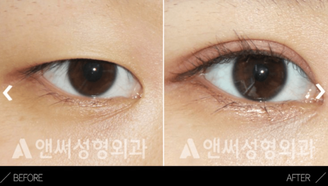 Ptosis Correction