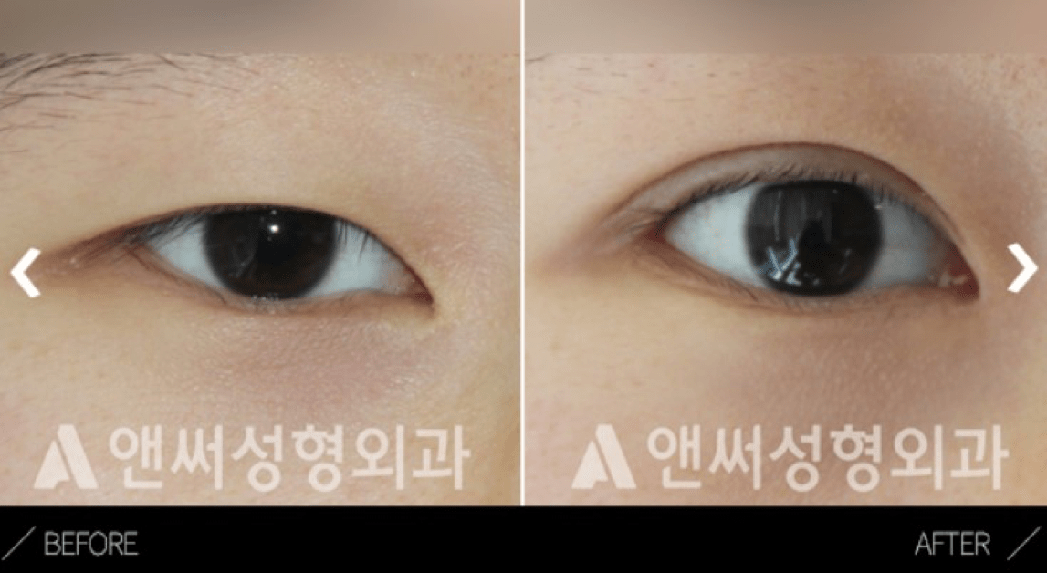 Ptosis Correction