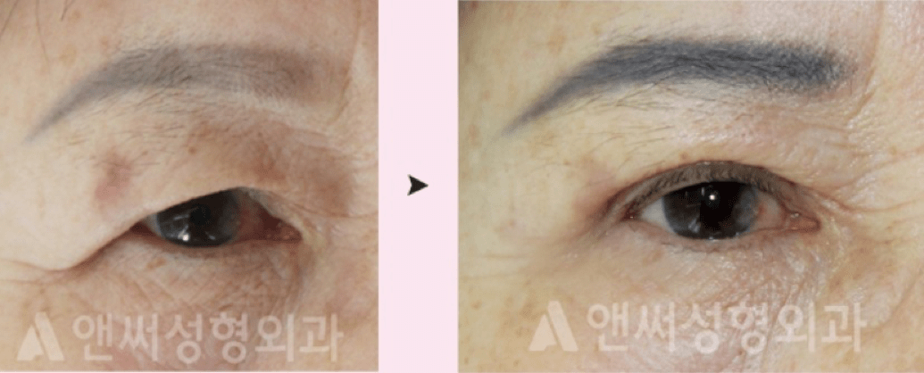 Upper Blepharoplasty in Korea