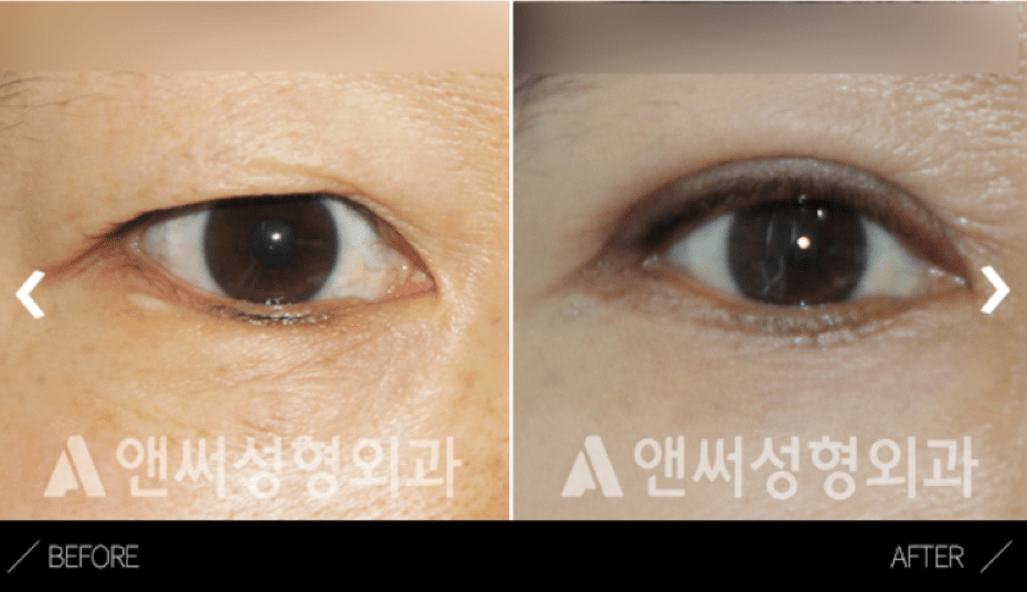Upper Blepharoplasty in Korea