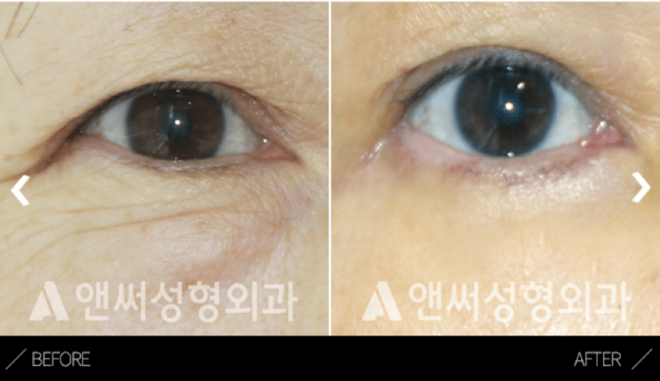 Upper Blepharoplasty in Korea