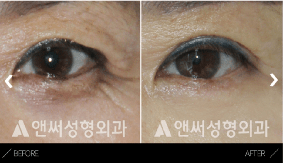 Upper Blepharoplasty in Korea