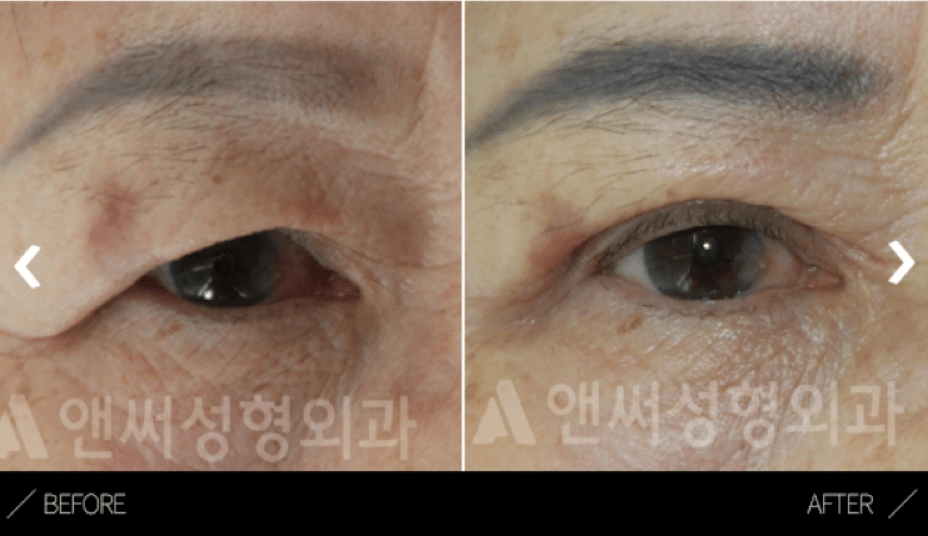 Upper Blepharoplasty in Korea