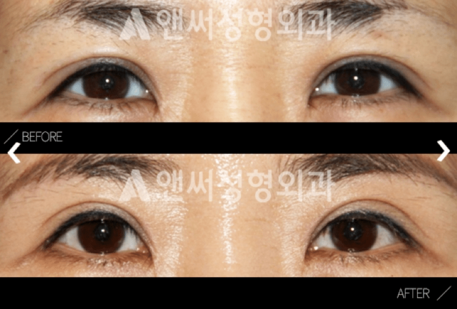 Eyebrow Lift