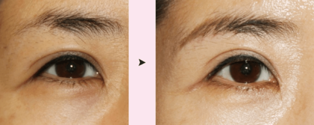 Eyebrow Lift