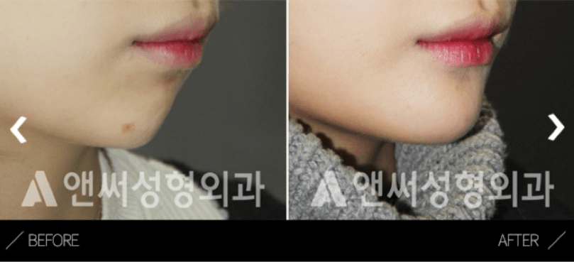 Forehead Implant In Korea