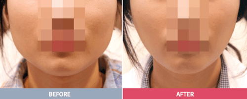 Botox - Quick Facts You Should Know About Botox in Korea