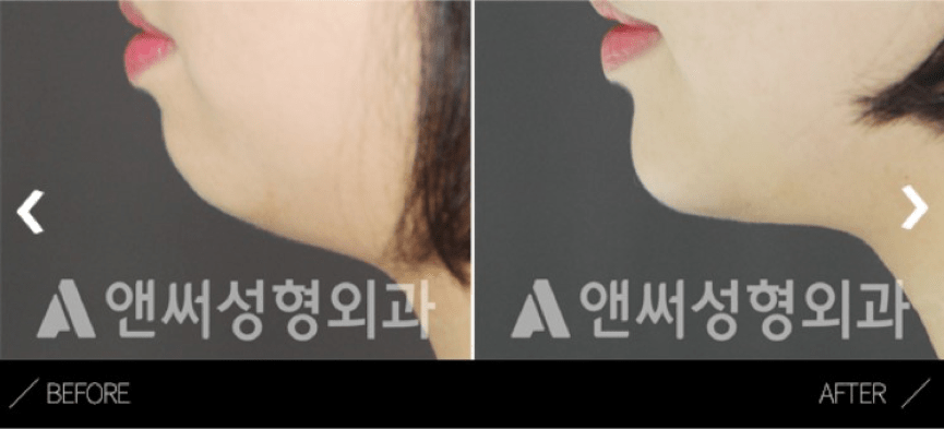 Forehead Implant In Korea