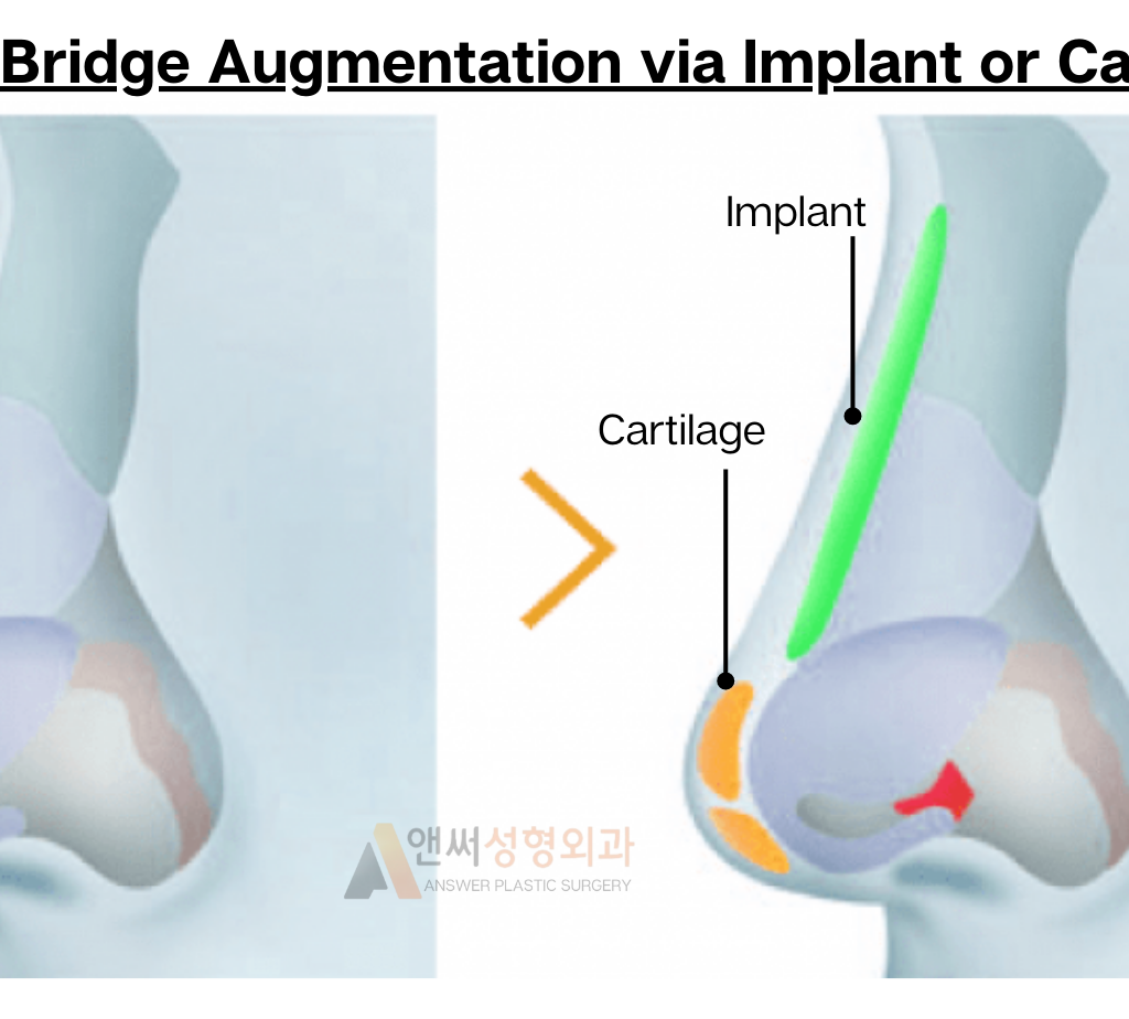 Nose Bridge Correction and Augmentation Nose Bridge Correction and Augmentation