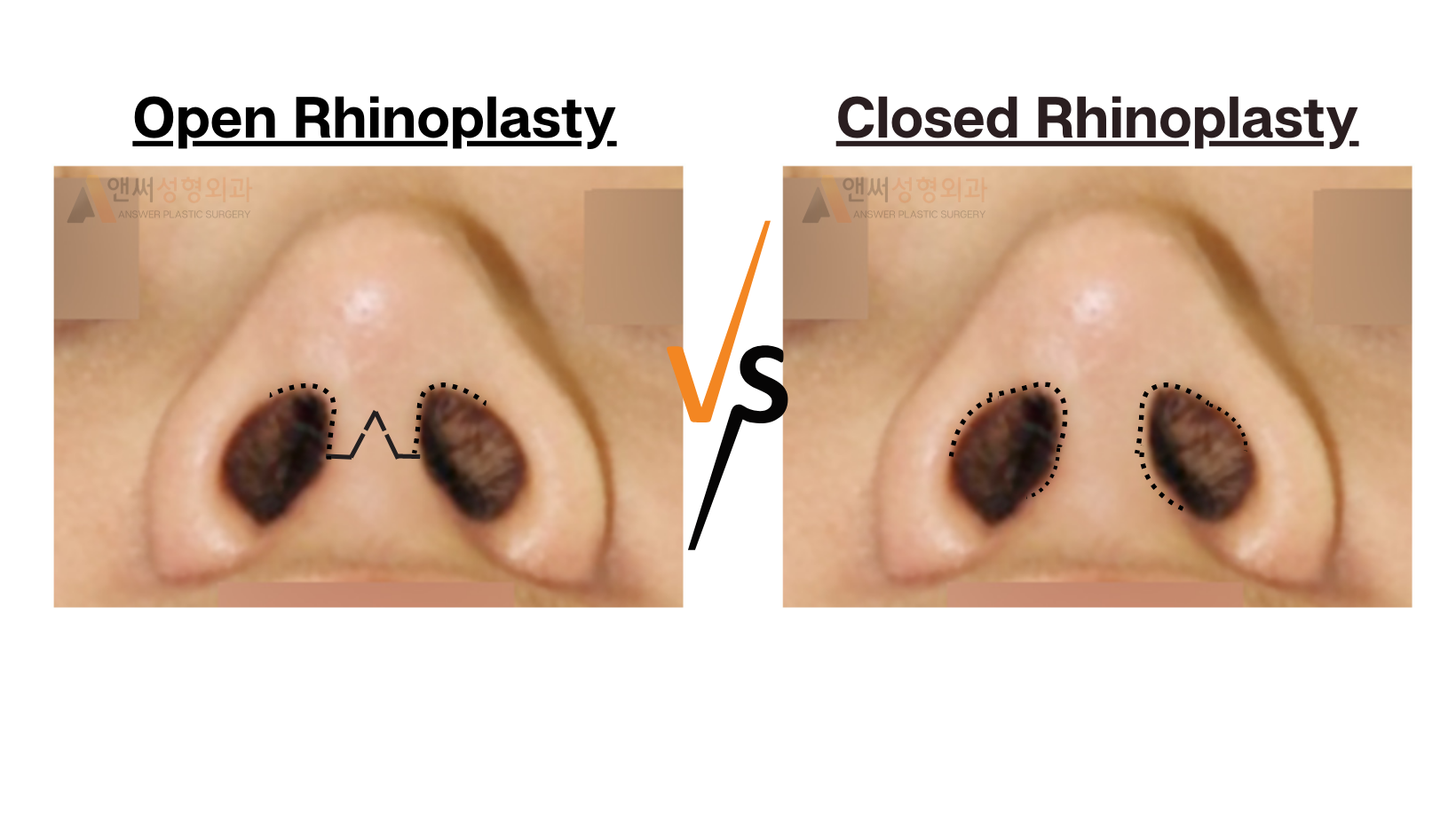 RHINOPLASTY RHINOPLASTY