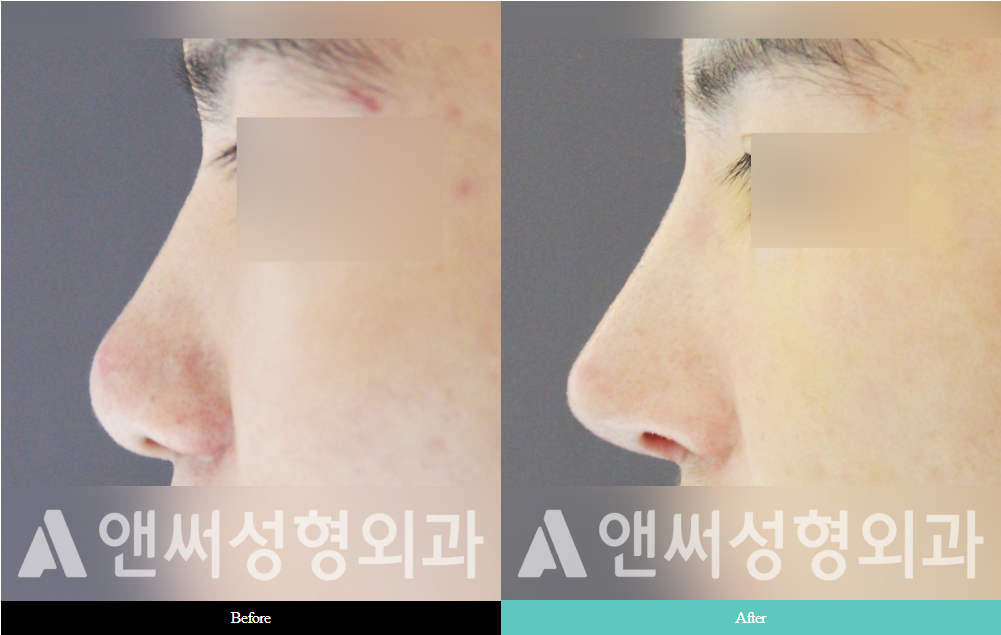 Men’s Rhinoplasty Men’s Rhinoplasty
