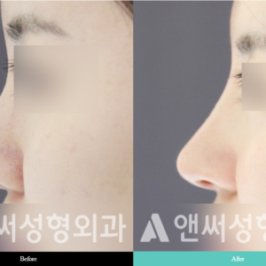 RHINOPLASTY RHINOPLASTY