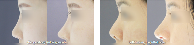 RHINOPLASTY RHINOPLASTY