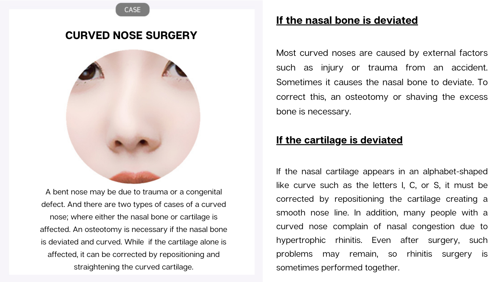 Curved Nose Rhinoplasty Curved Nose Rhinoplasty