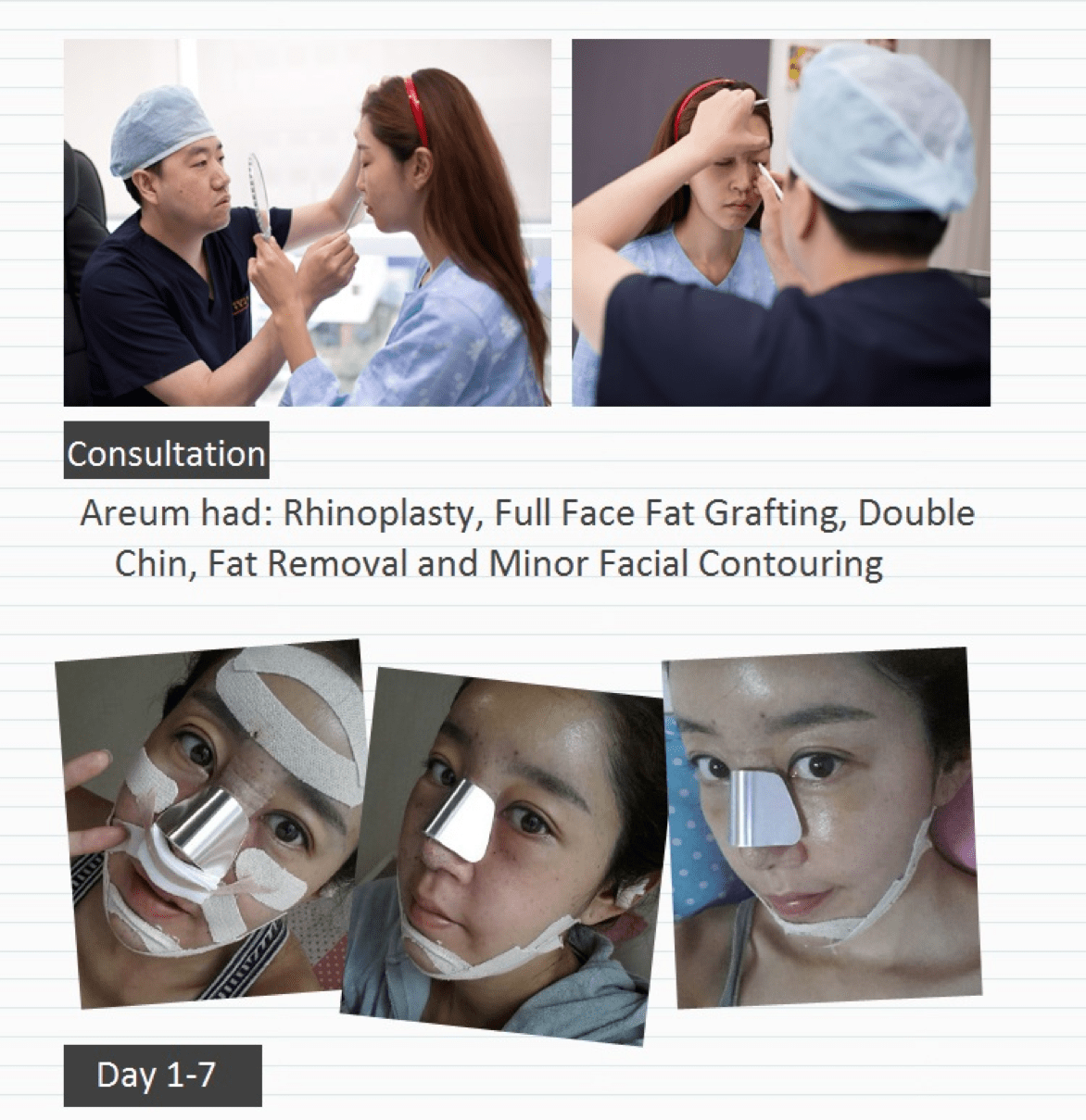 Fat Grafting, Facial Contouring, Rhinoplasty Before & After Fat Grafting, Facial Contouring, Rhinoplasty Before & After