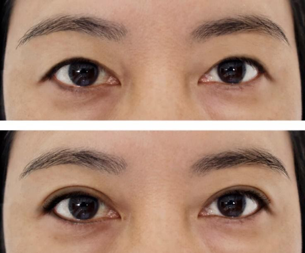 Double Eyelid Surgery in Korea - Definition, Procedure, Benefits, Recovery, Before and After
