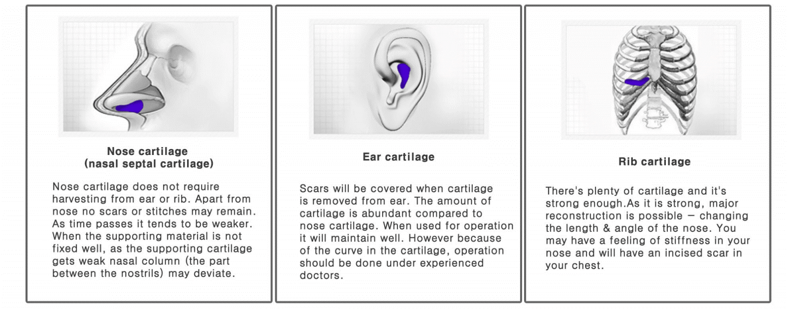 RHINOPLASTY RHINOPLASTY