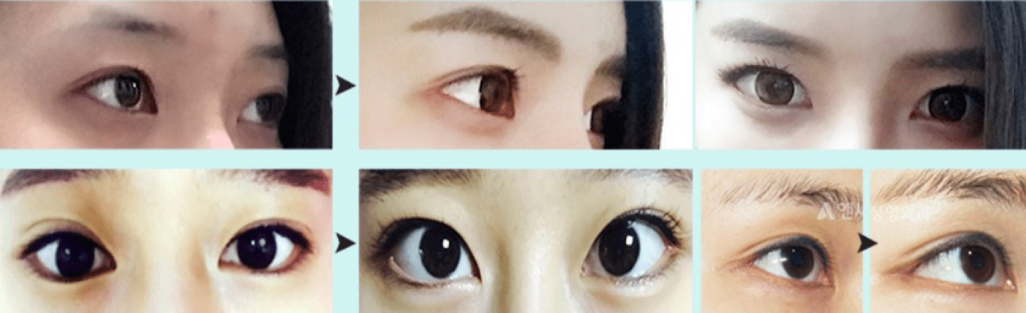 Lateral Canthoplasty in Korea