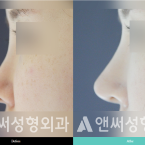 RHINOPLASTY RHINOPLASTY