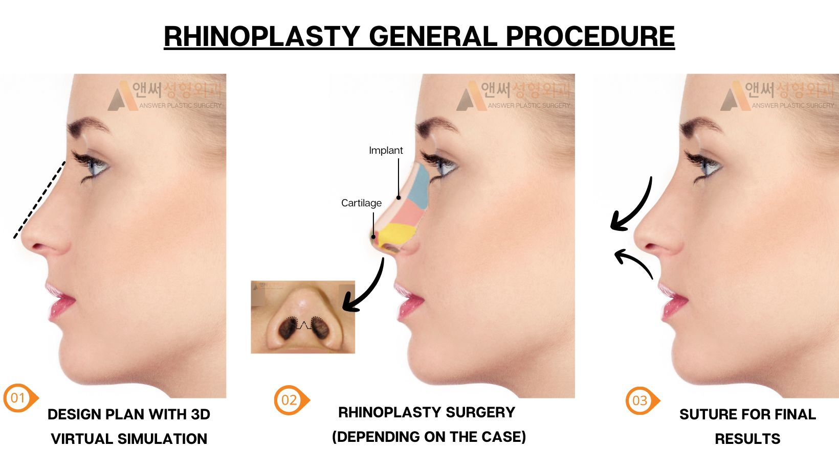 RHINOPLASTY RHINOPLASTY