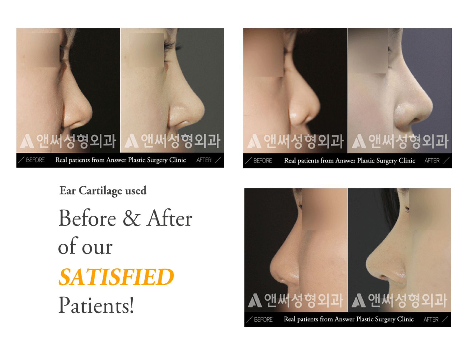 Rhinoplasty in Korea - Korean Nose Job Procedure