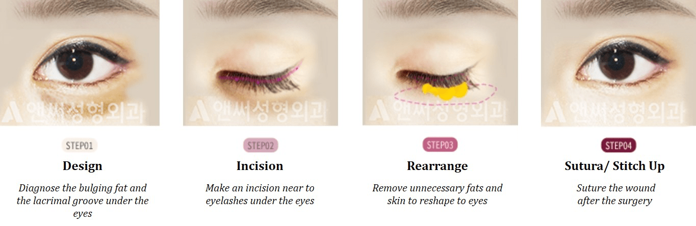 Lower Eye Blepharoplasty