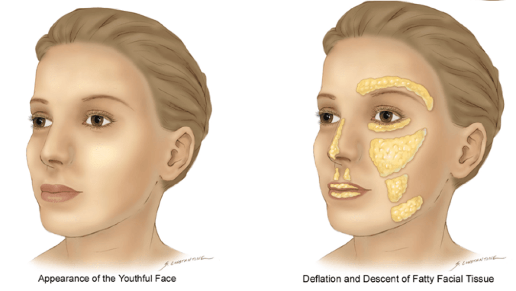 Fat Grafting Surgery In Korea, How Fat Grafting Works