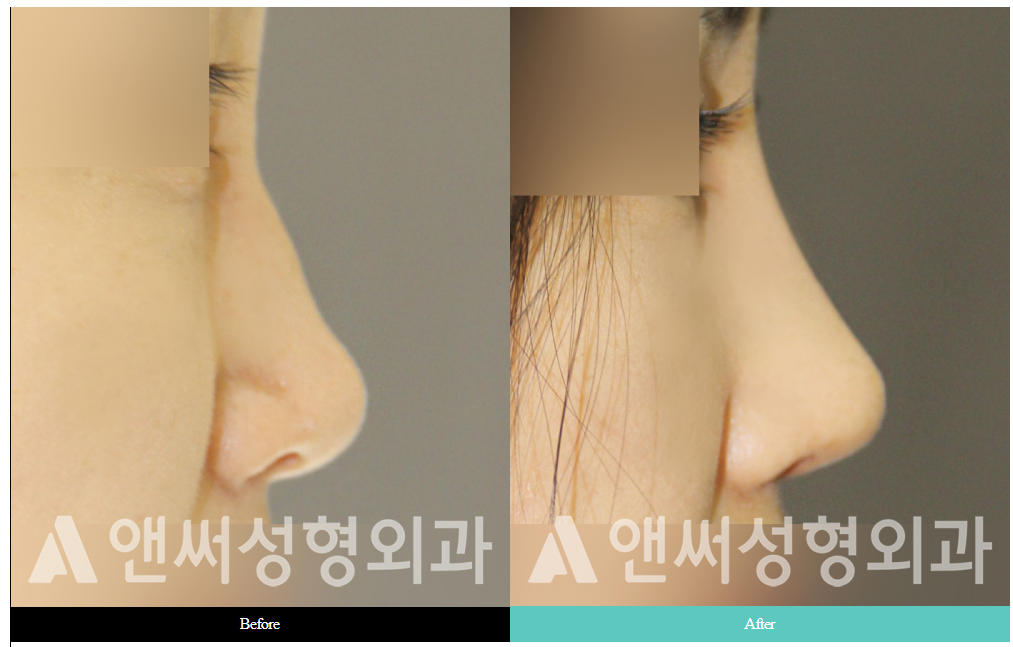 RHINOPLASTY RHINOPLASTY