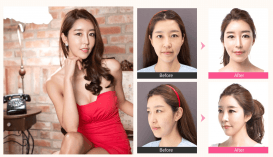 Fat Grafting, Facial Contouring, Rhinoplasty Before & After Fat Grafting, Facial Contouring, Rhinoplasty Before & After
