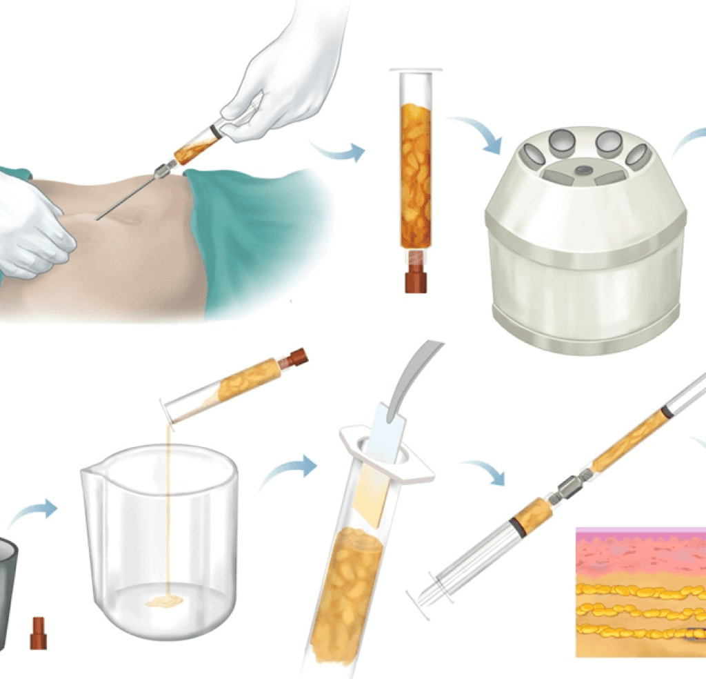 Fat Grafting Surgery In Korea, How Fat Grafting Works