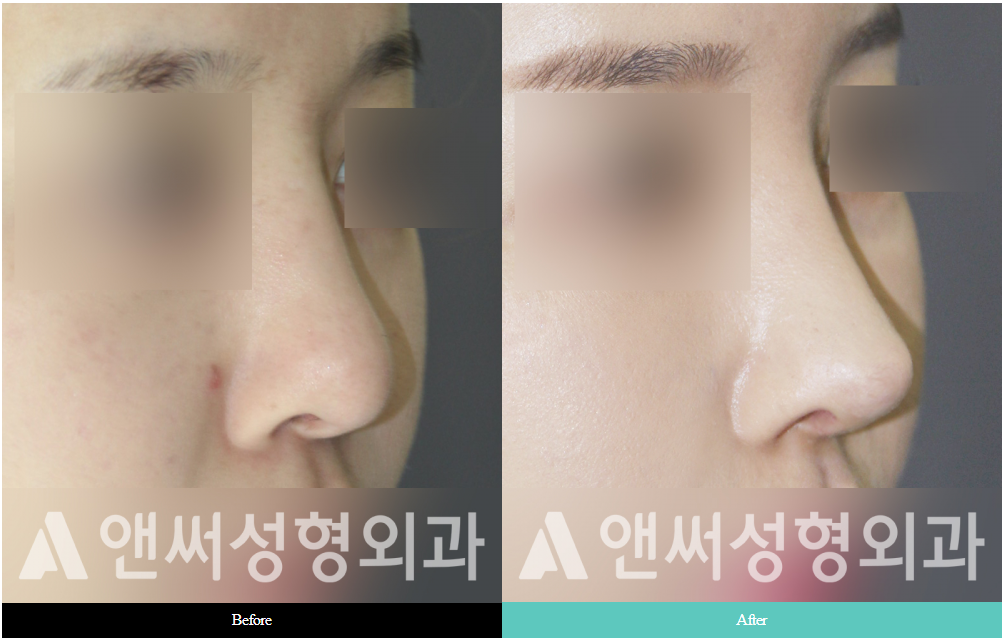 Nose Bridge Correction and Augmentation Nose Bridge Correction and Augmentation