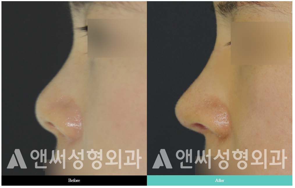 RHINOPLASTY RHINOPLASTY