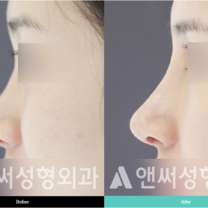 RHINOPLASTY RHINOPLASTY